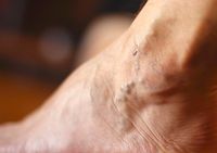 разширени вени лечение - 21233 промоции