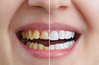 Invisalign - 44428 комбинации