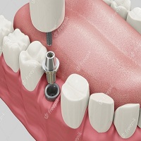 видове зъбни импланти - 7812 цени