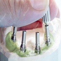 видове зъбни импланти - 52717 клиенти