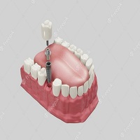 видове зъбни импланти - 10069 вида