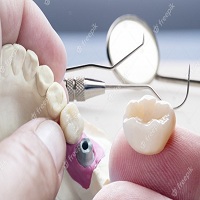 видове зъбни импланти - 86515 отстъпки