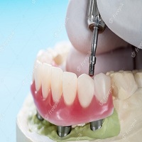 видове зъбни импланти - 80843 постижения
