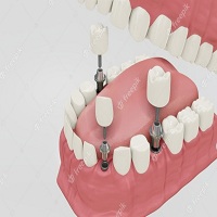 видове зъбни импланти - 47155 оферти