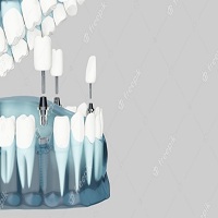 видове зъбни импланти - 94227 снимки