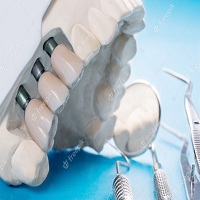 видове зъбни импланти - 71512 постижения