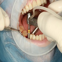 видове зъбни импланти - 92490 снимки