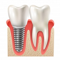 видове зъбни импланти - 46331 промоции