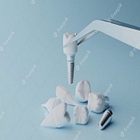 видове зъбни импланти - 76724 цени
