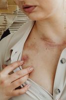 дискови хернии - 82329 варианти