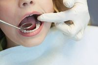 зъбни импланти - 37181 отстъпки