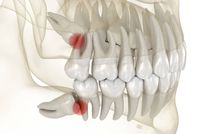 зъбни импланти - 15943 постижения