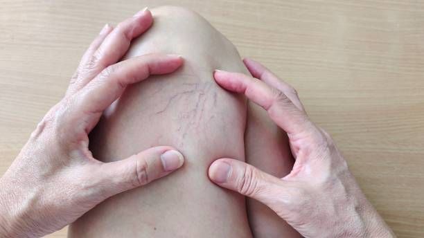 лечение на разширени вени - 19304 типа | medicabilis.eu лечение на разширени вени - 41826 типа