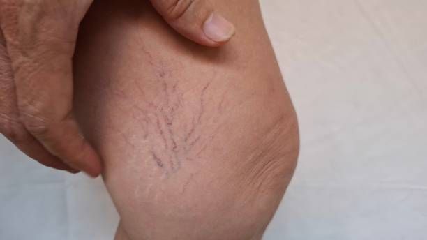 лечение на разширени вени - 27713 типа лечение на разширени вени - 6901 типа