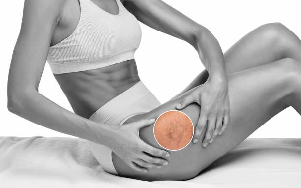 лечение на разширени вени - 10218 селекции лечение на разширени вени - 4408 селекции